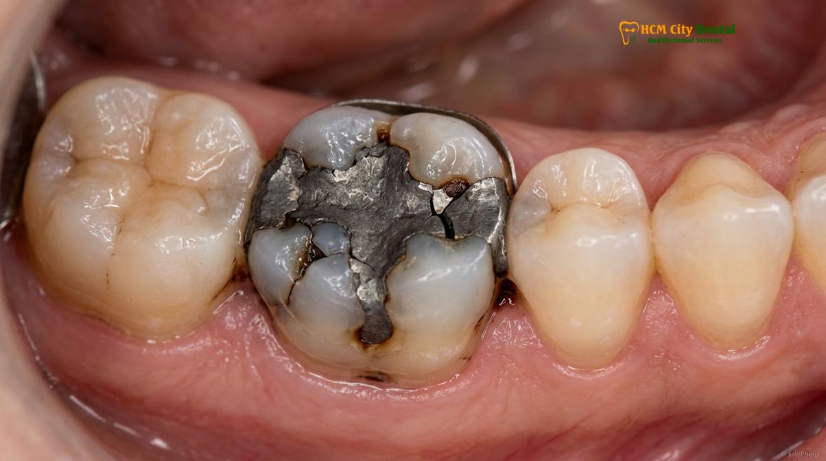 Clinical illustration of replace failing fillings with onlay