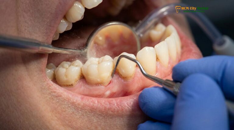 Deep Cleaning Teeth: Clinical Guide to Scaling & Root Planing | HCMC Dental