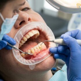 Dental Cleaning Before Whitening Veneers: Clinical Guide | HCMC Dental