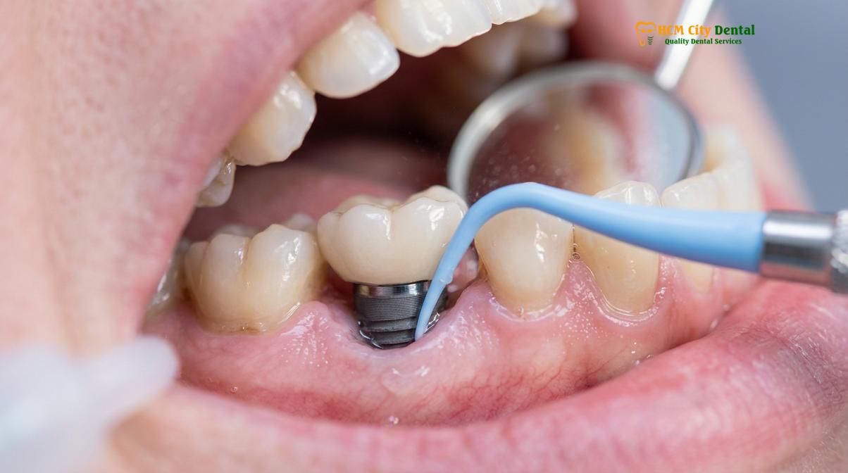 Clinical photography related to dental cleaning implants crowns bridges