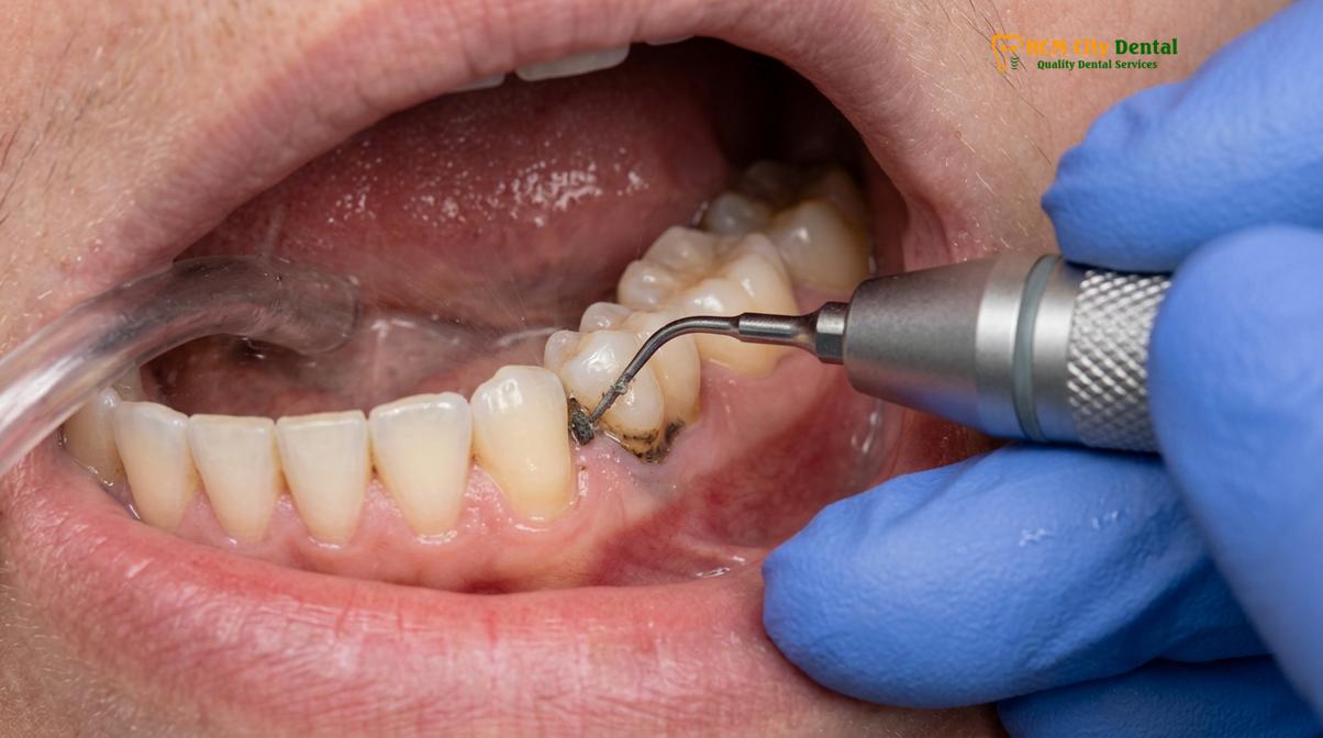 Visual description of dental cleaning pregnancy safe