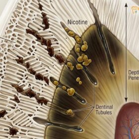 Dental Cleaning for Smokers: Removing Tobacco Stains & Calculus