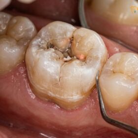 Crown After Root Canal: Clinical Guide | HCMC Dental