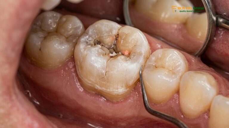 Crown After Root Canal: Clinical Guide | HCMC Dental