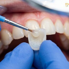 Comprehensive Clinical Guide to Dental Crown Caps | HCMC Dental