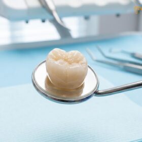 Crown Cost Vietnam: Complete Clinical Guide & Prices | HCMC Dental