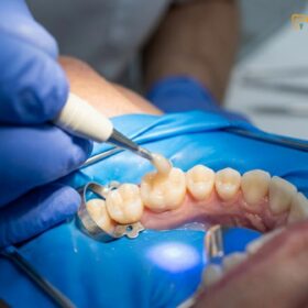 Dental Filling Cost Vietnam vs UK & Singapore | HCMC Dental