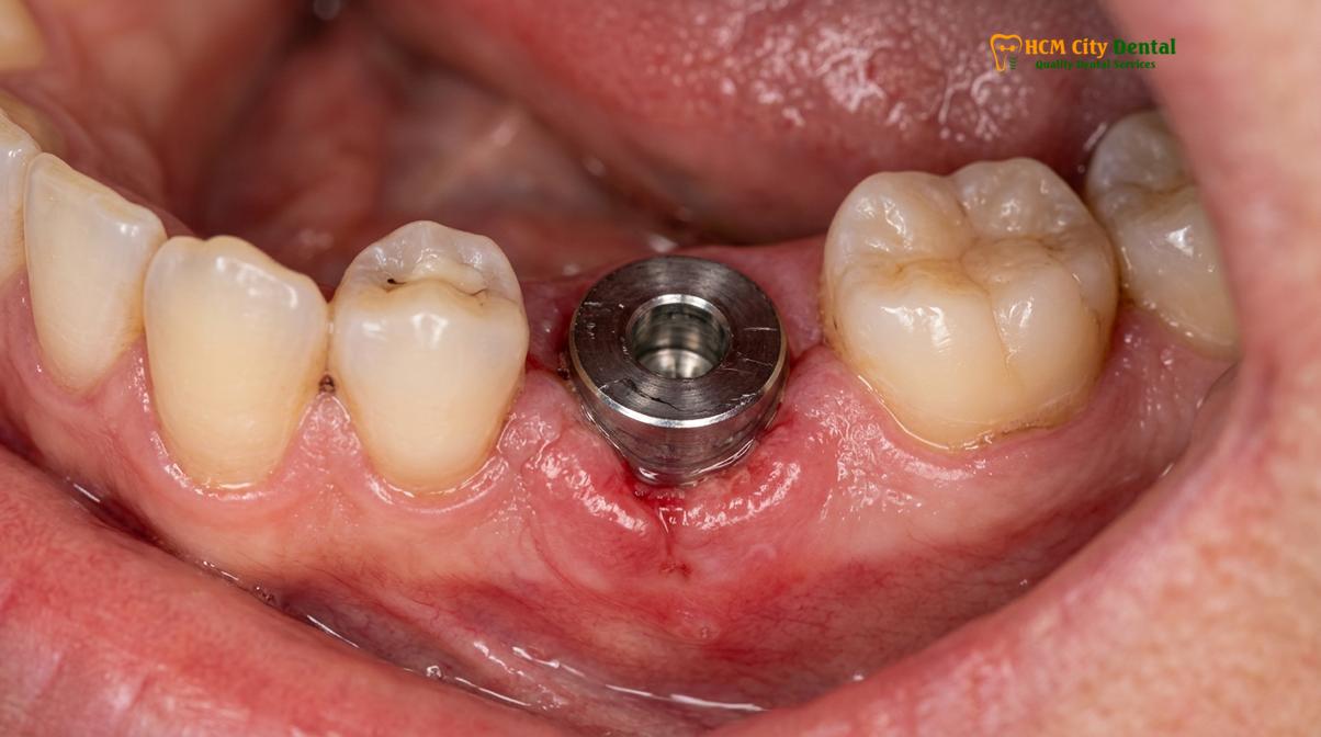 Clinical photography related to dental implant allergy