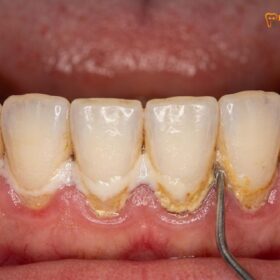 Dental Plaque vs Tartar: Clinical Differences & Removal Protocols