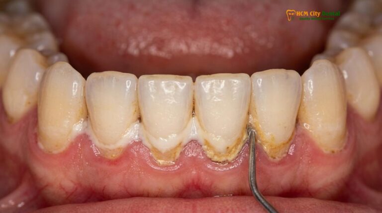 Dental Plaque vs Tartar: Clinical Differences & Removal Protocols