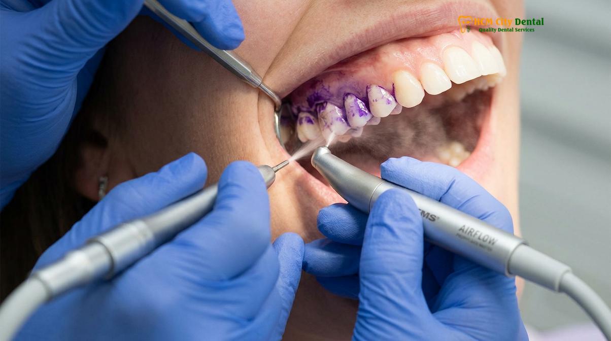 Visual description of dental scaling