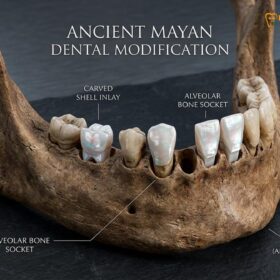 Dental Implant History Timeline: Evolution & Methods | HCMC Dental