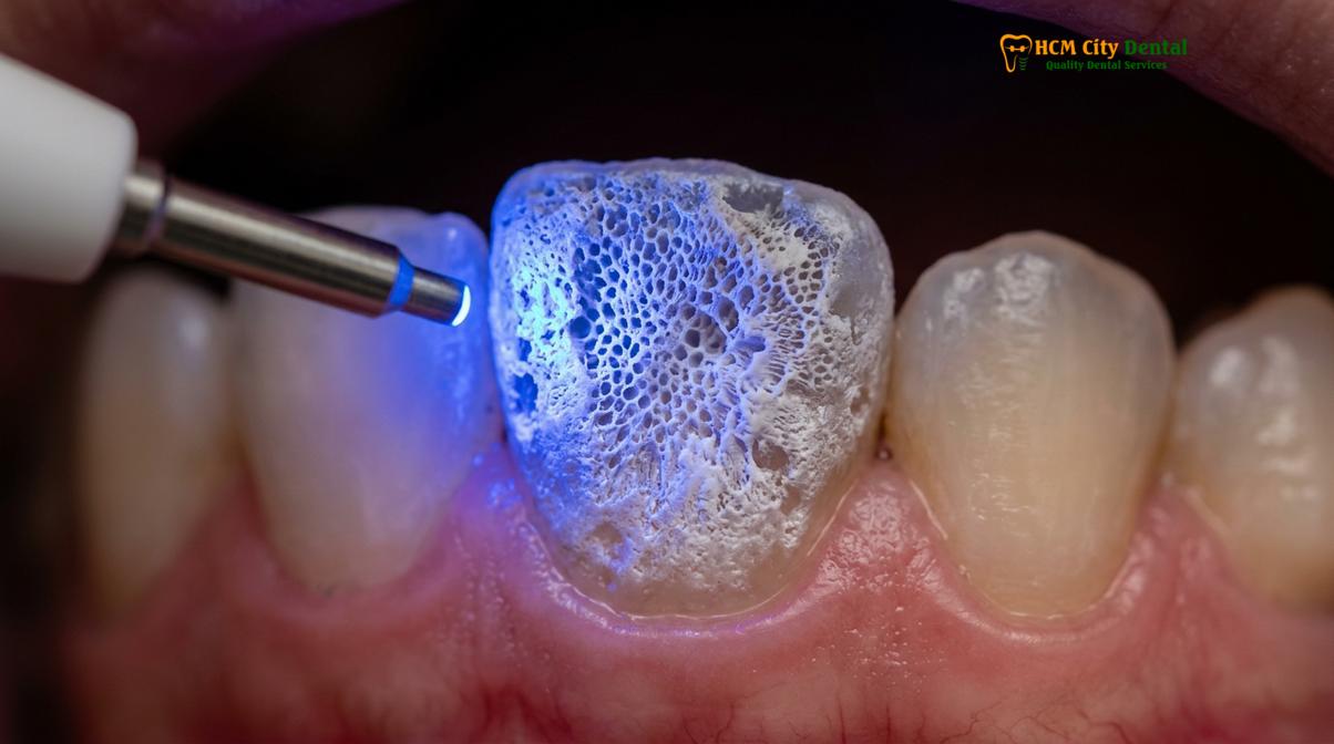 Clinical illustration of does cola stain your teeth