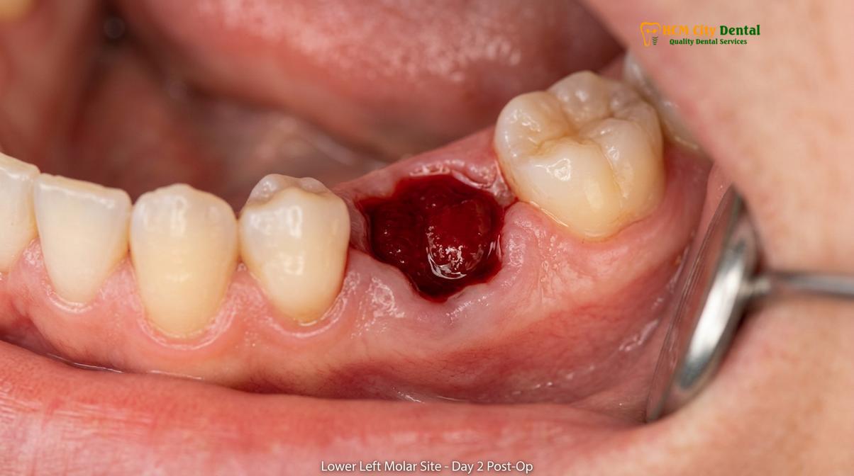 Clinical photography related to dry socket wisdom teeth