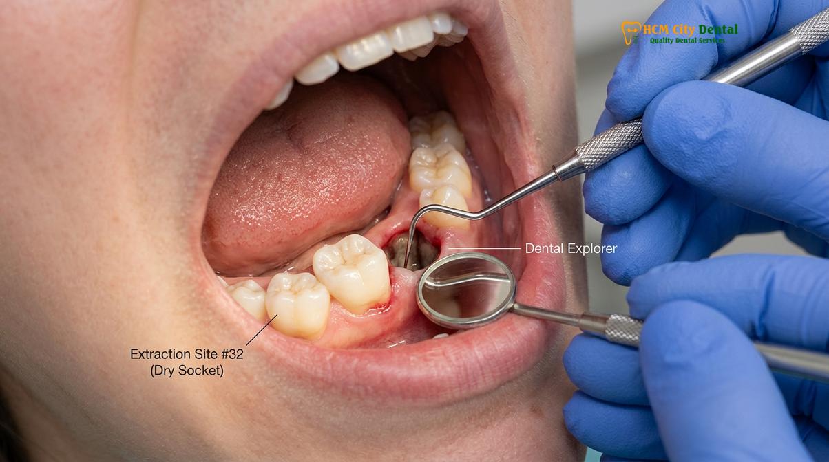 Clinical photography related to dry socket symptoms treatment