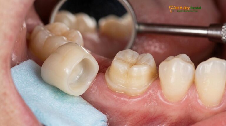 Emergency Loose Crown in Ho Chi Minh City: Clinical Guide & Repair