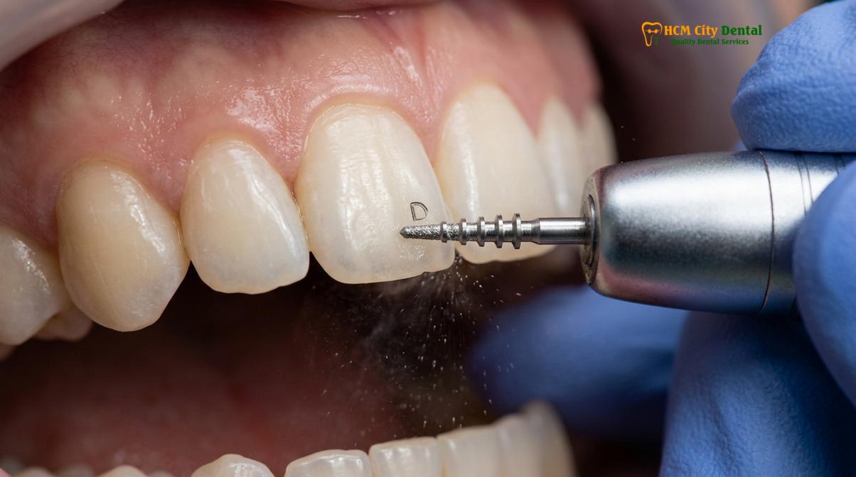Clinical illustration of enamel shaving for veneers