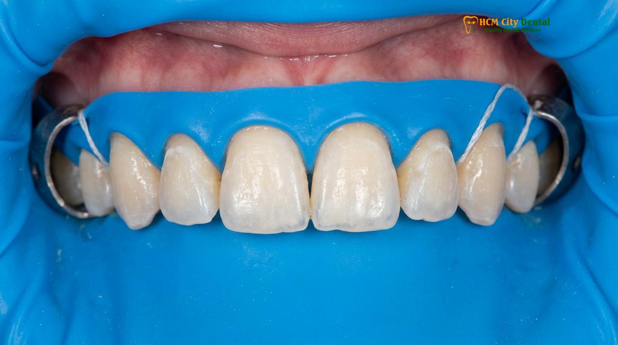 Visual description of enamel shaving for veneers