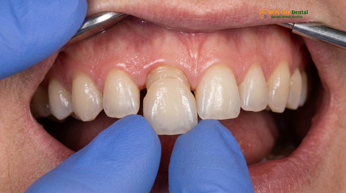 Visual description of dental insurance crowns Ho Chi Minh
