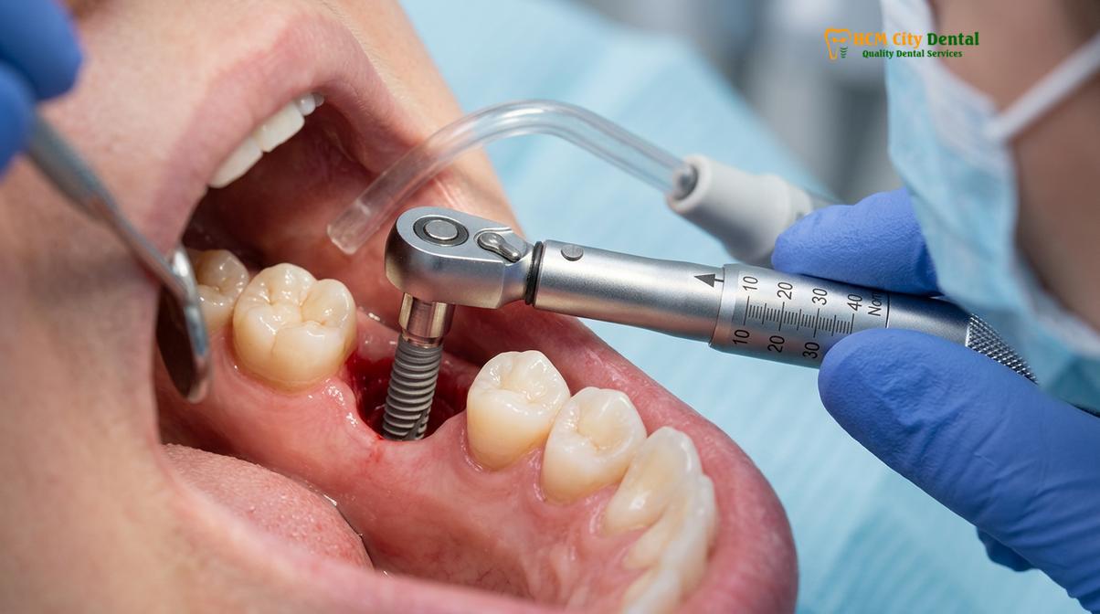 Visual description of Extraction Before Implant Denture Preparation