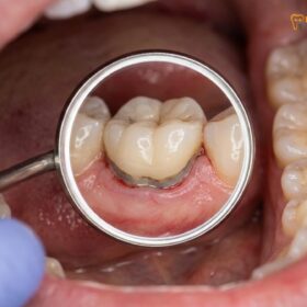 Failed Dental Crown Symptoms: Clinical Signs & Replacement Guide