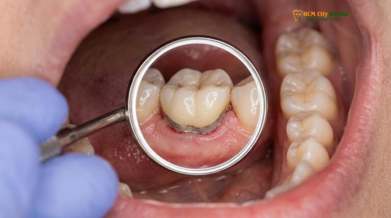Failed Dental Crown Symptoms: Clinical Signs & Replacement Guide