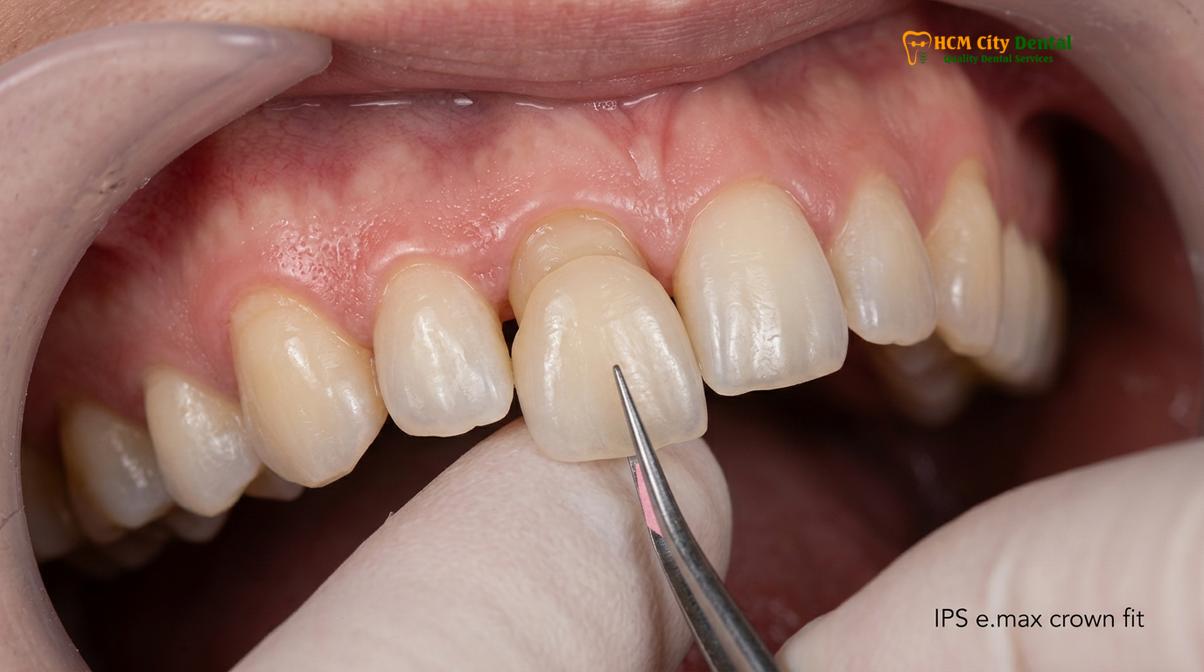 Visual description of failed dental crown symptoms