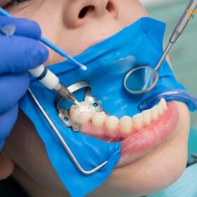 Fissure Sealant vs Fluoride Varnish: Clinical Pediatric Guide