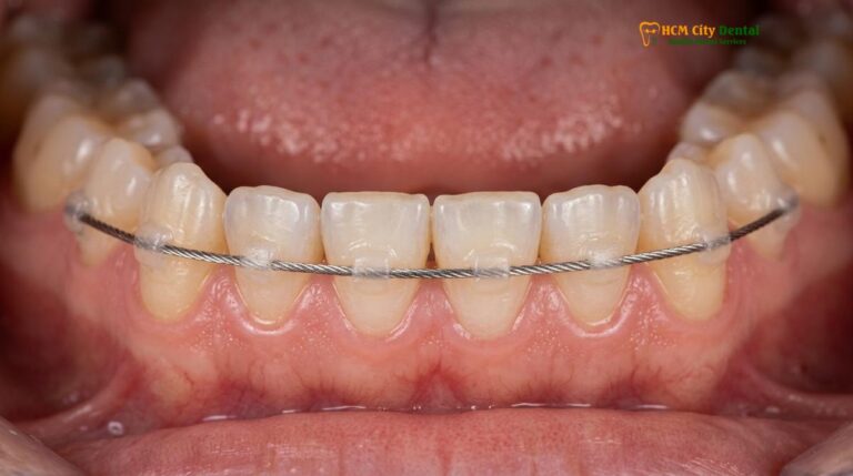 Fixed Permanent Retainer Price Vietnam: Clinical Guide | HCMC Dental
