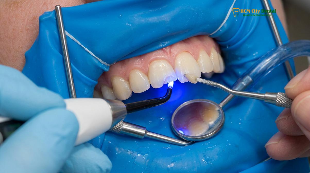 Clinical photography related to repair chipped veneer