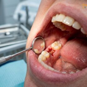 Foods to Eat After Wisdom Teeth Removal: Clinical Guide | HCMC Dental