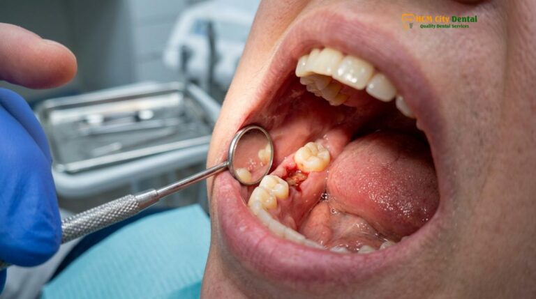 Foods to Eat After Wisdom Teeth Removal: Clinical Guide | HCMC Dental