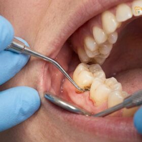 Full Mouth Disinfection: Clinical Protocol & Efficacy | HCMC Dental