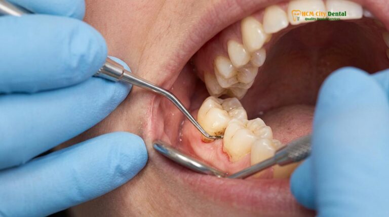 Full Mouth Disinfection: Clinical Protocol & Efficacy | HCMC Dental