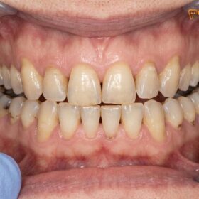 Full Mouth Reconstruction for Seniors: Clinical Protocols & Safety