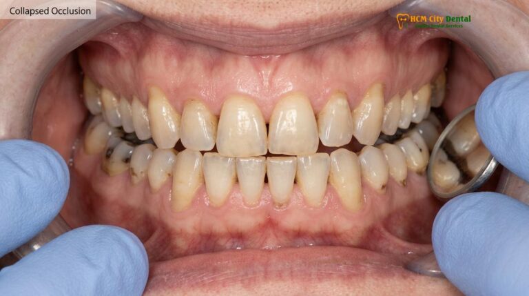 Full Mouth Reconstruction for Seniors: Clinical Protocols & Safety