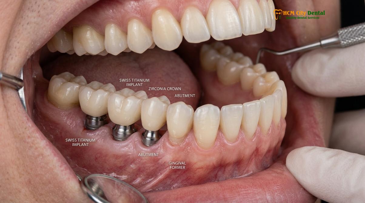 Visual description of full mouth reconstruction cost vietnam vs australia