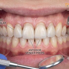 Combining Implants and Veneers: Full Mouth Rehabilitation Guide