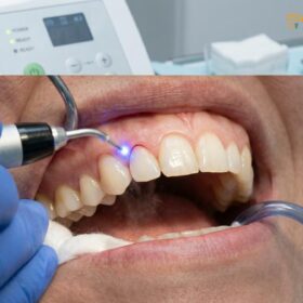 Crown Lengthening for Veneers HCMC: Clinical Guide & Costs