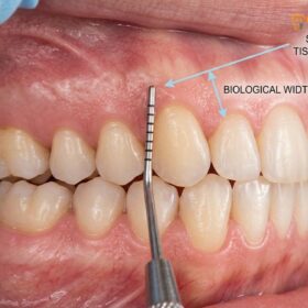 Gingivectomy Infection Signs: Clinical Warnings & Healing Guide