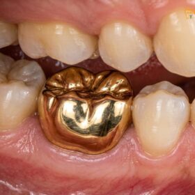 Gold Crowns for Back Teeth: Clinical Benefits & Cost Guide
