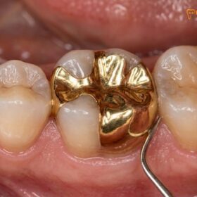 Gold Inlay Back Teeth: Clinical Guide to Molar Restorations