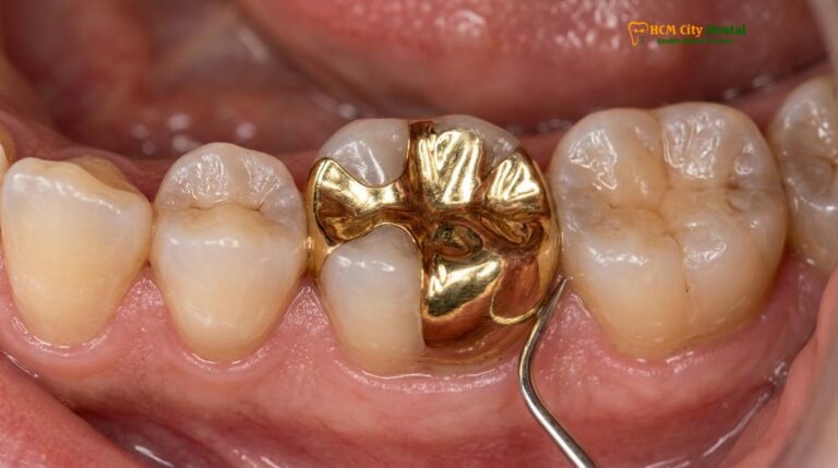 Gold Inlay Back Teeth: Clinical Guide to Molar Restorations
