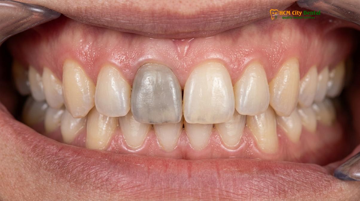 Visual illustration of grey tooth causes