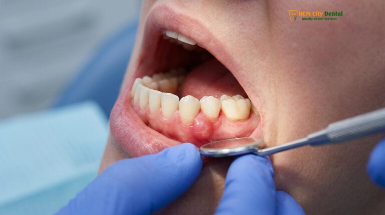 Gum Abscess Treatment: Clinical Guide & Drainage | HCMC Dental