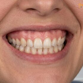 Gum Contouring Price Saigon: Comprehensive Clinical Fee Guide