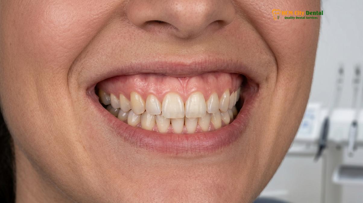 Gum Contouring Price Saigon: Comprehensive Clinical Fee Guide