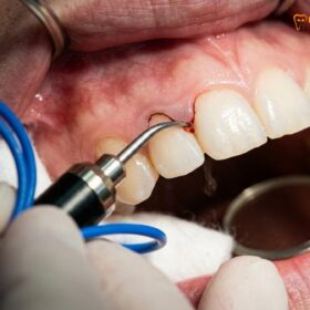 Gum Contouring Cost in Vietnam: Clinical Pricing & Procedure Guide