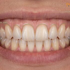 Gum Contouring with Veneers: Clinical Guide & Treatment Workflow