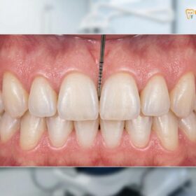Gum Contouring Pain: Clinical Recovery Guide & Management